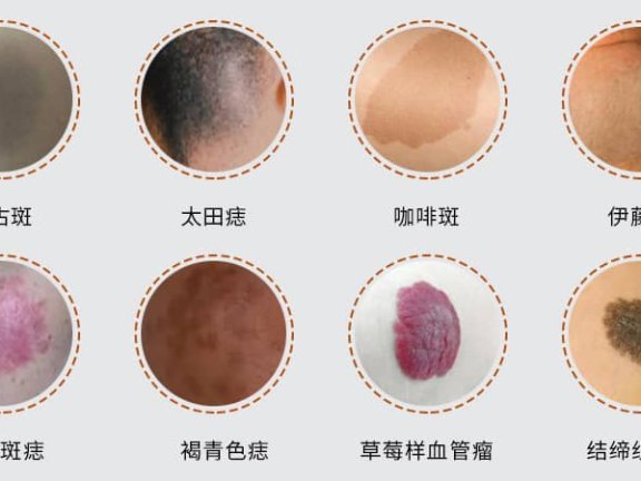 激光去除胎记需要多少钱？