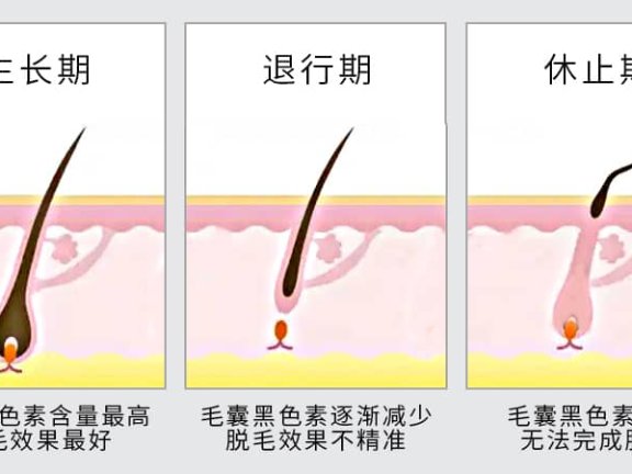 激光脱毛常见问题解答