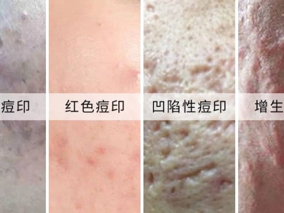脸上痘印怎么去除？