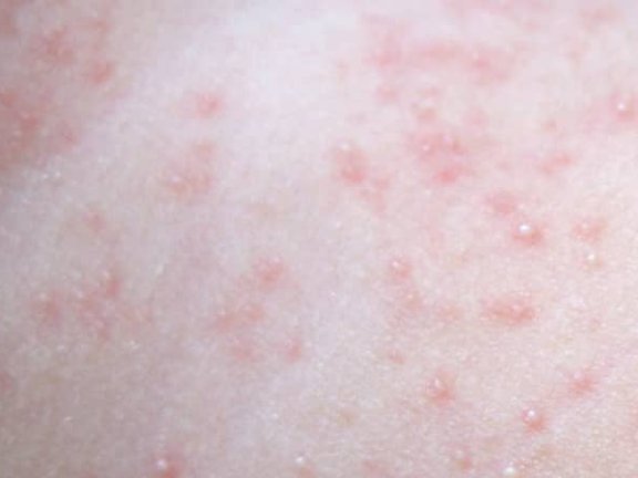 夏天常见皮肤病有哪些？