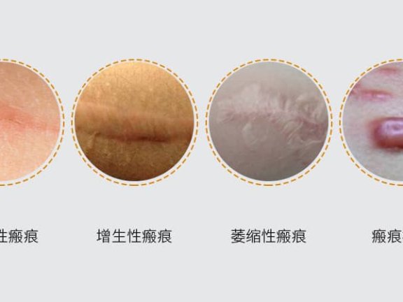 疤痕与瘢痕之间有什么区别？
