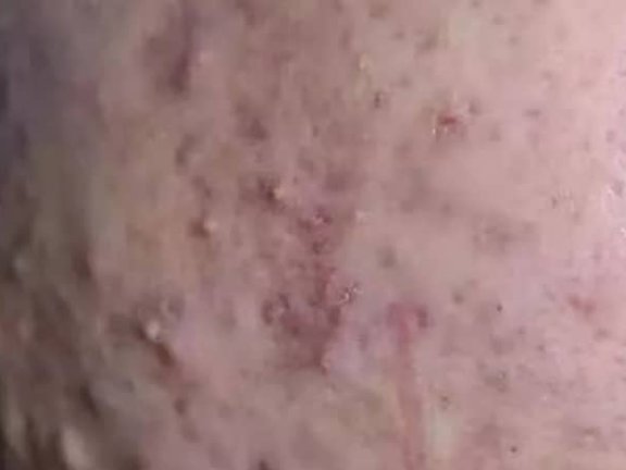 结节性痤疮怎么治疗