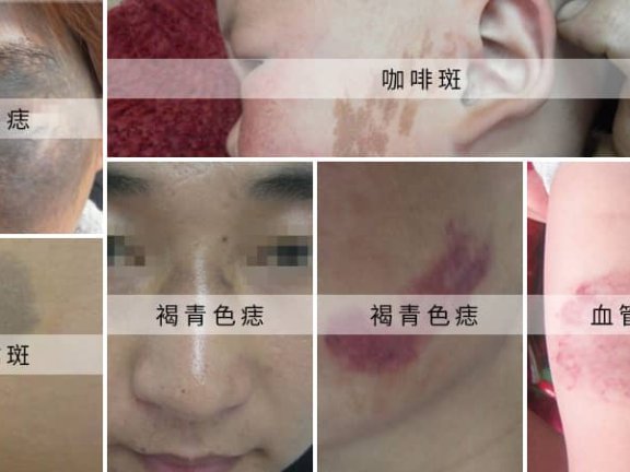 胎记是怎么形成的？