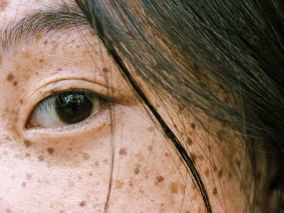 为什么她的斑仅治疗2次就很干净了，我的斑已经治疗多次还没见明显好转？